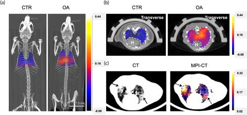 First magnetic particle imaging to assess pulmonary vascular leakage in vivo in the acutely injured and fibrotic lung