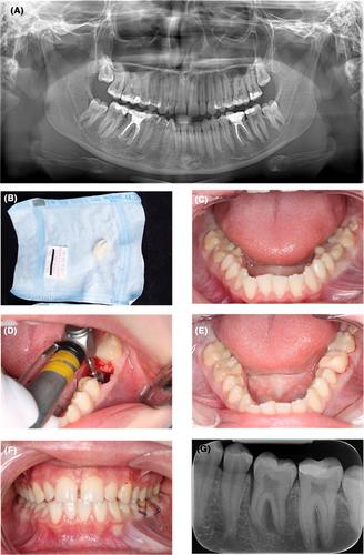 Effect of 3D printed replicas on the duration of third molar autotransplantation surgery: A controlled clinical trial