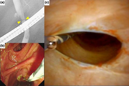 Potential versatile uses of a novel ultra-thin peroral cholangioscope