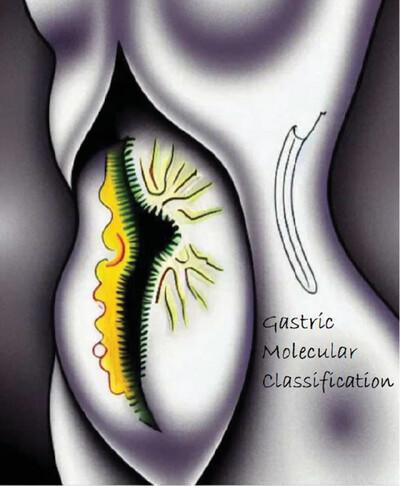 Molecular profile of gastric adenocarcinoma, relevant epidemiological factors – Systematic review and meta-analysis relating sex with Epstein-Barr virus and unstable microsatellites subtypes