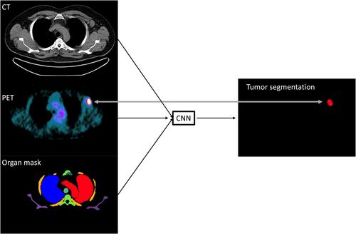 Metabolic tumour volume in Hodgkin lymphoma—A comparison between manual and AI-based analysis