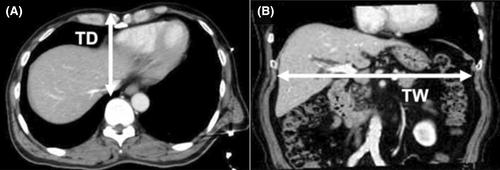 Impact of thoracic shape on the surgical outcomes of laparoscopic-assisted living donor hepatectomy