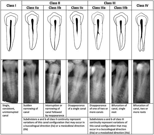 Prevalence and morphology of different root canal systems in mandibular premolars: a cross-sectional observational study