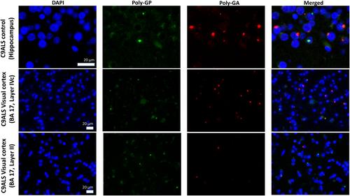 Primary visual cortex pathology in ALS patients with C9ORF72 expansion