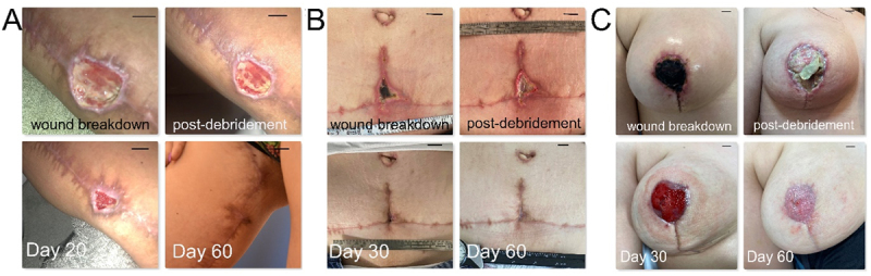 Full-thickness dermal wound regeneration using hypoxia preconditioned blood-derived growth factors: A case series.