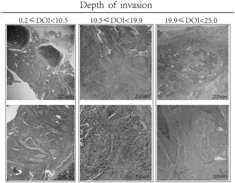 Integrating DOI in T classification improves the predictive performance of laryngeal cancer staging.