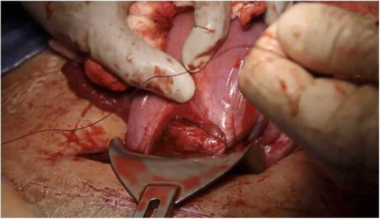 Horizontal mattress uterine closure compared to single layered lock suture in cesarean section - A retrospective cohort study