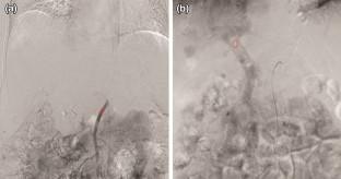 Severity of Liver Cirrhosis Evaluated by Digital Subtraction Angiography Using Quantitative Color-Coding Analysis Before Transarterial Embolization