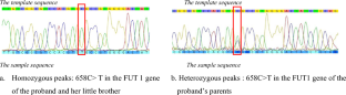 A Pedigree Investigation of H-antigen Deletion Caused by Mutation of 658 C to T in the FUT1 Gene.