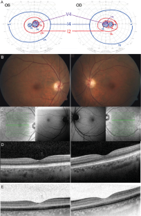 Occult retinopathy following treatment of Hepatitis C with glecaprevir/pibrentasvir (Mavyret).