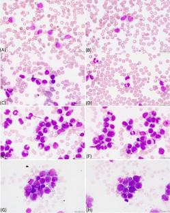 The Frequency, Clinico-Hematological Features, and Outcome of Acute Promyelocytic Leukemia with Variant <i>RARA</i> Rearrangements: A Single Center Experience from India.