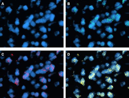 PDGFRA, KIT, and KDR Gene Amplification in Glioblastoma: Heterogeneity and Clinical Significance.