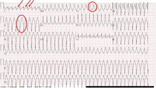 Idiopathic fascicular ventricular tachycardia in children: a challenging arrythmia worth recognizing.