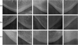 Fully Automated Detection of Osteoporosis Stage on Panoramic Radiographs Using YOLOv5 Deep Learning Model and Designing a Graphical User Interface