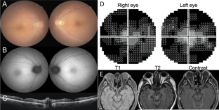 Melanoma-associated retinopathy with anti-TRPM1 autoantibodies showing concomitant Off-bipolar cell dysfunction.