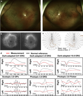 Bilateral macular hole in a patient with CAPN5-related neovascular inflammatory vitreoretinopathy.