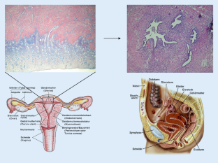 [Holistic treatment of endometriosis].