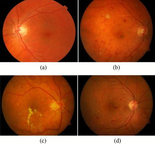 Detection and diabetic retinopathy grading using digital retinal images