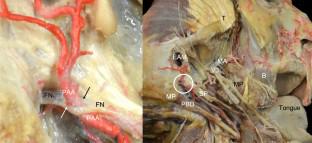 Penetration of the facial nerve by the posterior auricular artery: case report, comprehensive review and clinical–surgical applications