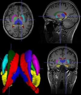 Changes in the volumes and asymmetry of subcortical structures in healthy individuals according to gender