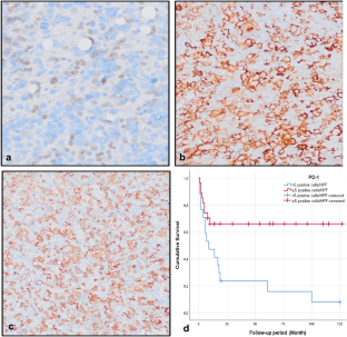 The Prognostic Impact of Tumor Microenvironment and Checkpoint Blockade-Associated Molecules (PD-1, PD-L1, CD163 and CD14) in Nodal Diffuse Large B-cell Lymphoma, NOS.