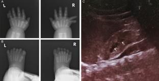 Bardet-Biedl syndrome associated with novel compound heterozygous variants in BBS12 gene.