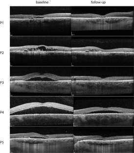 Safety of intravitreal metoprolol in eyes with central serous chorioretinopathy.