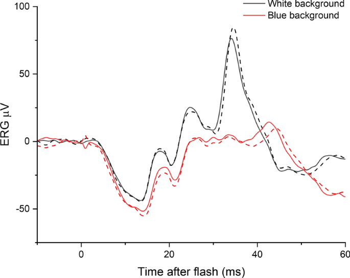 Cone-driven strong flash electroretinograms in healthy adults: Prevalence of negative waveforms.