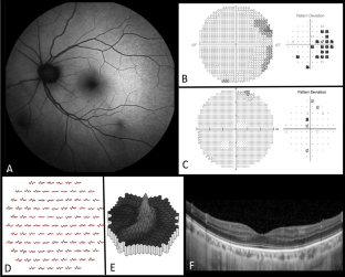 Accelerated hydroxychloroquine toxic retinopathy.