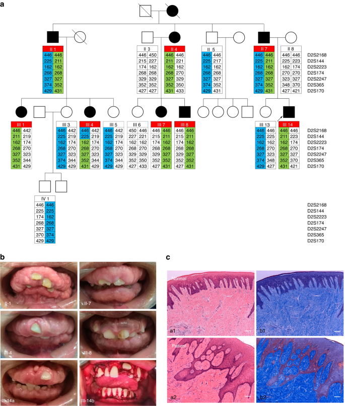 Double heterozygous pathogenic mutations in KIF3C and ZNF513 cause hereditary gingival fibromatosis.