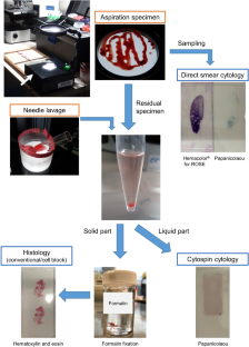 Tissue processing of endoscopic ultrasound-guided fine-needle aspiration specimens from solid pancreatic lesions.