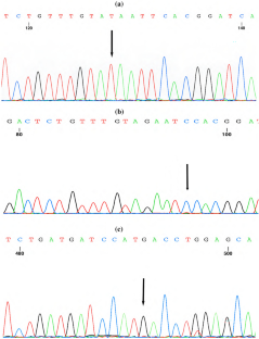 Mutation detection and inhibitor analysis of 43 children with severe hemophilia A in a single center: three novel mutations.