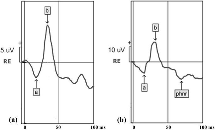 Full-field electroretinogram recorded with skin electrodes in 6- to 12-year-old children.