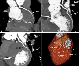 Relationship between myocardial bridging and fatal ventricular arrhythmias in patients with hypertrophic cardiomyopathy: the HCM-MB study.