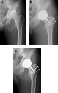 Long-term results of hemi-resurfacing and metal-on-metal hip resurfacing for osteonecrosis of the femoral head.