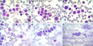 Acute mast cell leukemia without KIT D816V mutation and lack of CD2 and CD25-a case report of rare entity.