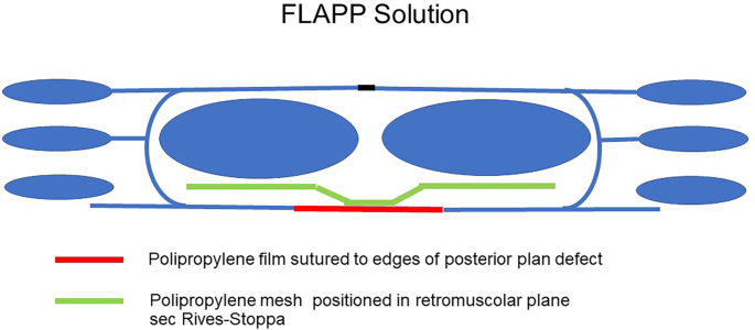 A modified Rives–Stoppa technique with composite mesh (FLaPp) in large incisional hernia: a multicentric retrospective cohort study