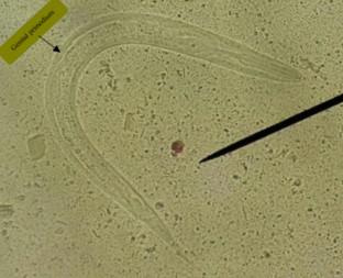 Fatal Disseminated Strongyloidiasis in an Immunosuppressed Patient During COVID-19 Pandemic