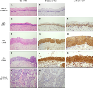 Elevated expression of endocan in the development of cervical squamous neoplasia of the uterus.