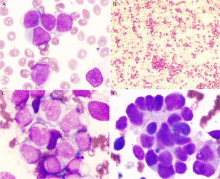 Concurrence of relapsed neuroblastoma and therapy-related acute myeloid leukemia in an 8-year-old patient