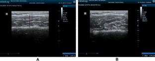 Evaluation of the thickness and internal structure of the masseter muscle with ultrasonography in female bruxism patients.