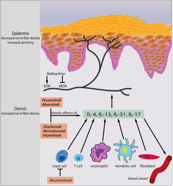 Chronic Prurigo Including Prurigo Nodularis: New Insights and Treatments.