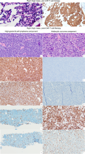 Transdifferentiation of high-grade B-cell lymphoma with MYC and BCL2 rearrangements into histiocytic sarcoma after CAR T-cell therapy: a case report