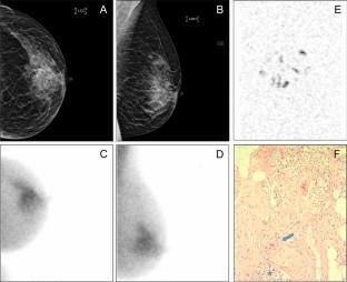 Molecular imaging to guide breast cancer surgery