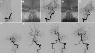 An Update on the Treatment of Basilar Artery Occlusion