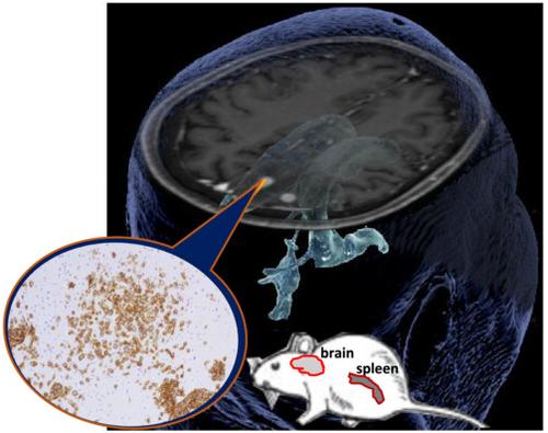 Patient-derived xenograft mouse models to investigate tropism to the central nervous system and retina of primary and secondary central nervous system lymphoma.