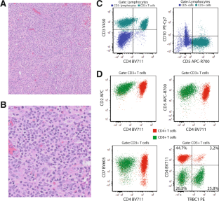 TRBC1 enables identification of an otherwise immunophenotypically silent case of angioimmunoblastic T-cell lymphoma.