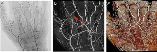 Combined cone-beam CT imaging and microsurgical dissection of cadaver specimens to study cerebral venous anatomy: a technical note.