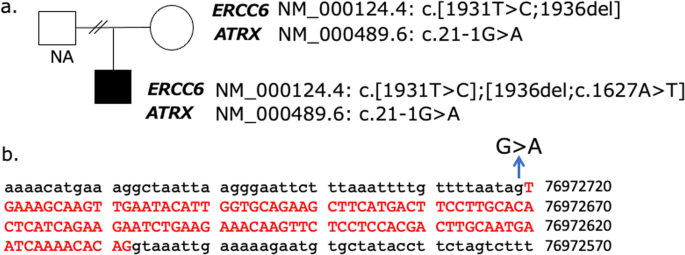 The ATRX splicing variant c.21-1G>A is asymptomatic.