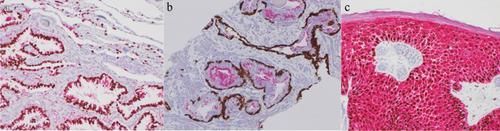 Carcinoma of unknown primary (CUP): an update for histopathologists.